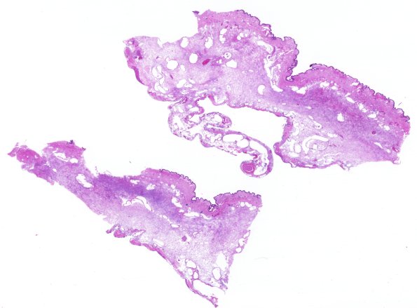 8C6-Encephalocoele-Case-8-skin-H-E-whole-mount