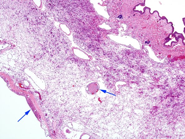 8C7-Encephalocoele-Case-8-skin-H-E-2-copy