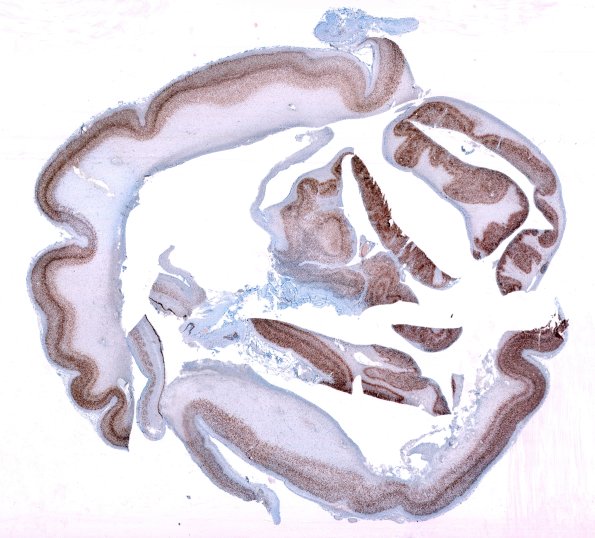 8D1 Encephalocoele (Case 8) whole mount NeuN