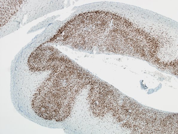 8D3 Encephalocoele (Case 8) NeuN 2