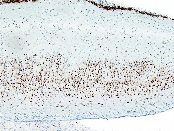 8D4 Encephalocoele (Case 8) NeuN 3