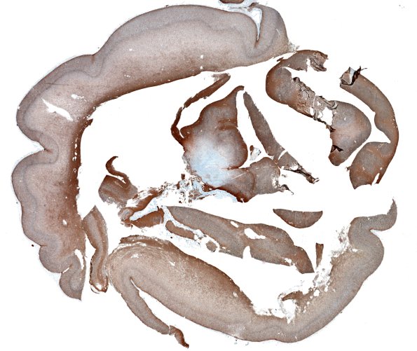 8E1 Encephalocoele (Case 8) whole mount GFAP