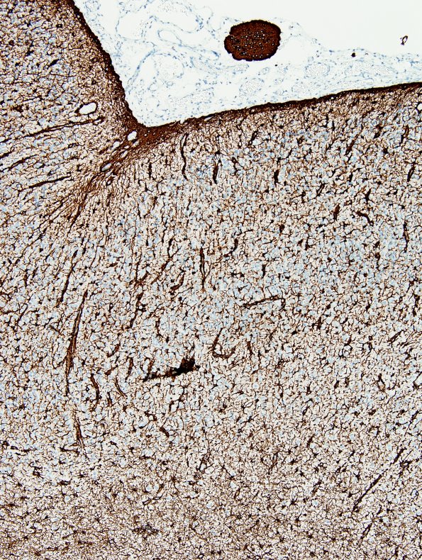 8E2 Encephalocoele (Case 8) GFAP 3