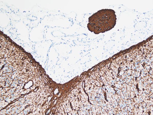 8E3 Encephalocoele (Case 8) GFAP 2