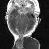 9A1 Encephalocoele (Case 9) T1 W - Copy