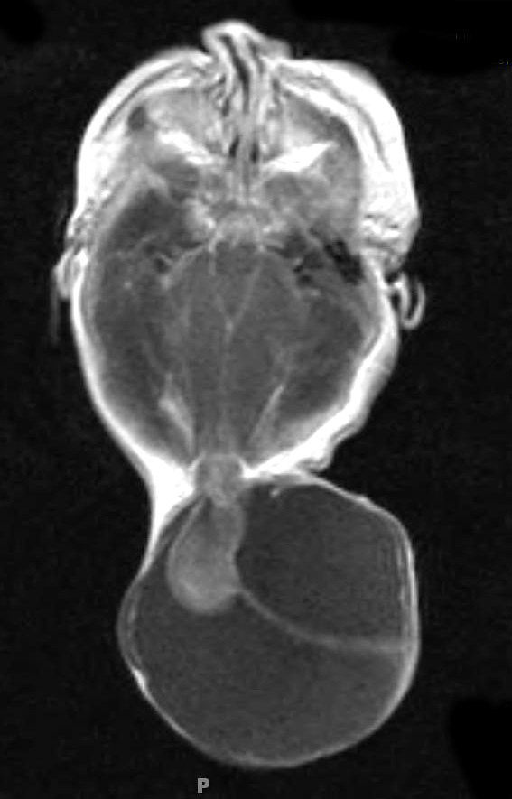 9A1 Encephalocoele (Case 9) T1 W - Copy