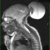 9A2 Encephalocoele (Case 9) T2 3 - Copy