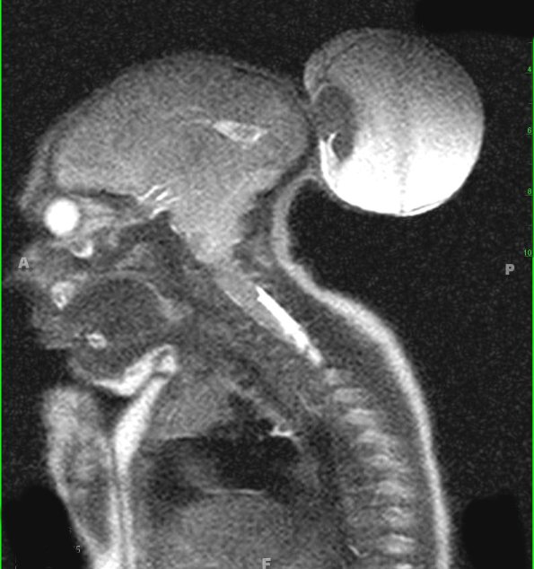 9A2 Encephalocoele (Case 9) T2 3 - Copy