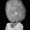 9A3 Encephalocoele (Case 9) T2 - Copy