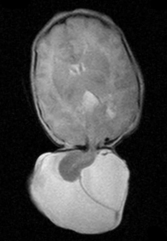 9A3-Encephalocoele-Case-9-T2-Copy