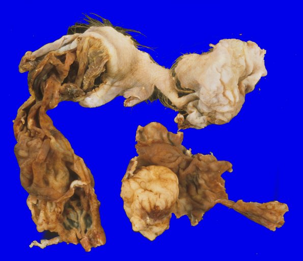 9B1 Encephalocoele (Case 9) gross 2