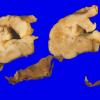 9B3 Encephalocoele (Case 9) gross 1