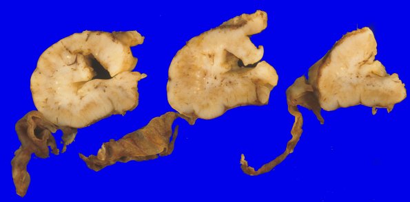9B3 Encephalocoele (Case 9) gross 1