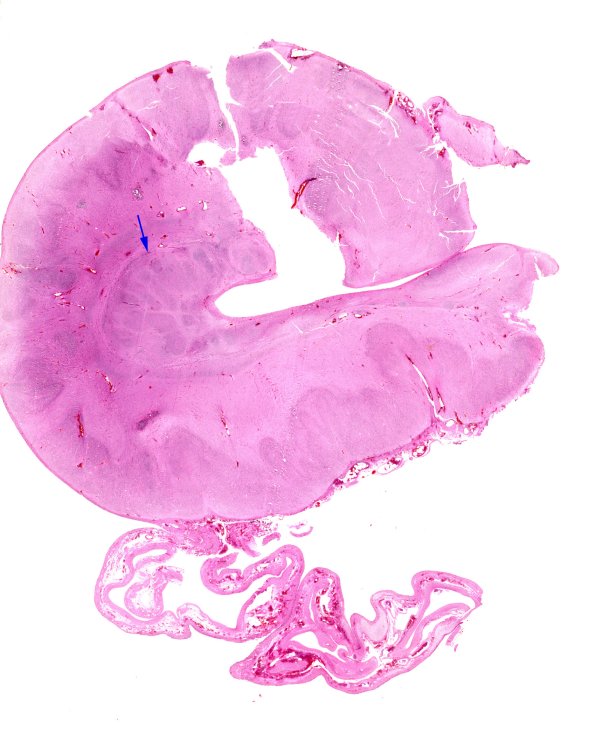 9C1 Encephalocoele (Case 9) H&E whole mount copy