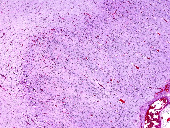 9C2 Encephalocoele (Case 9) H&E 1