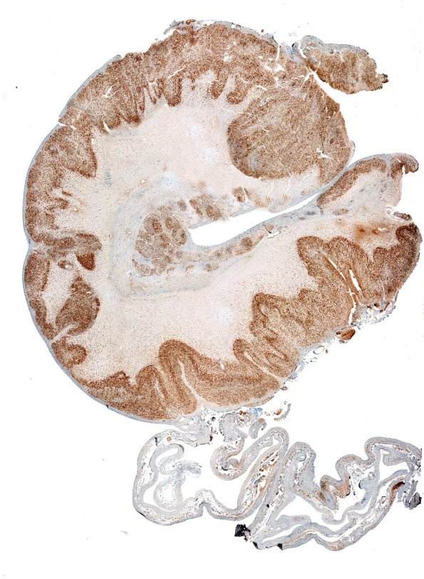 9D Encephalocoele (Case 9) NeuN whole mount 2