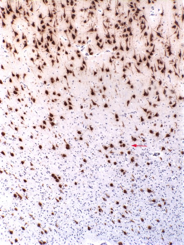 2A1 Microdysgenesis (Case 2) WM NeuN 2