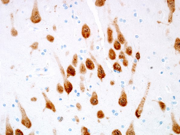 4A2 Microdysgenesis, Neuronal Clumping (Case 4) NeuN 1