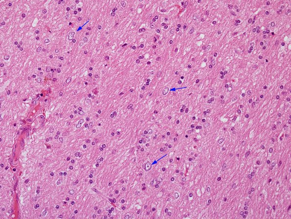 5A3 Microdysgenesis (Case 5) H&E WM 5