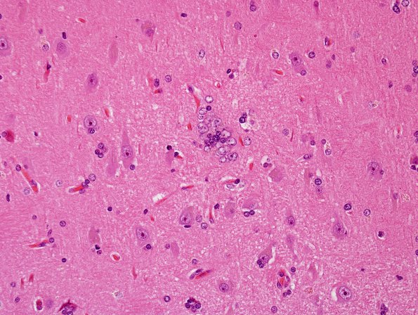 5A7 Microdysgenesis (Case 5) H&E 2