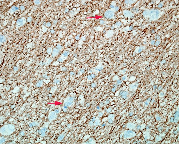 5B1 Microdysgenesis (Case 5) NF 3.