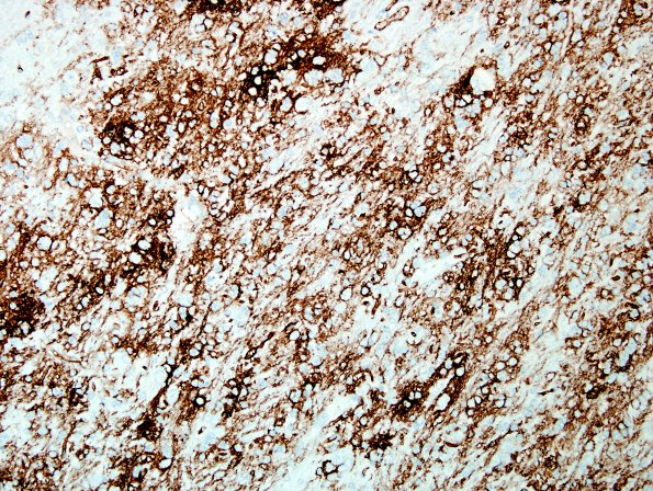 5B3 Microdysgenesis (Case 5) CD34 WM labeled 1A