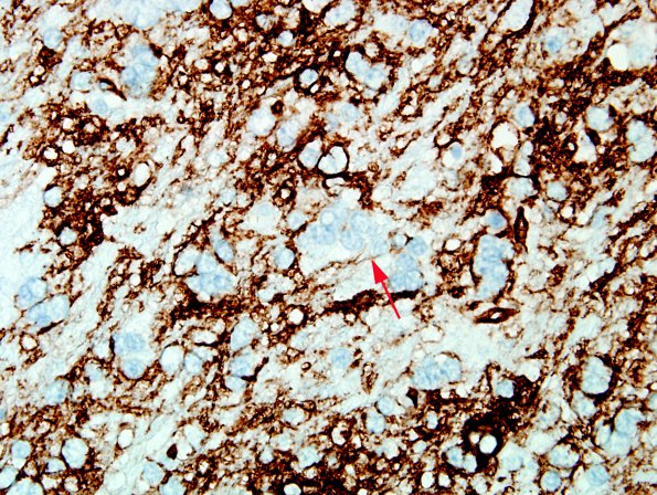 5B4 Microdysgenesis (Case 5) CD34 WM 6A