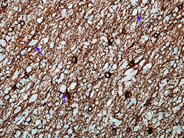 5B5 Microdysgenesis (Case 5) GFAP WM 3A