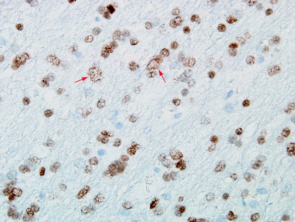 5B6 microdysgenesis (Case 5) Olig2 WM 2