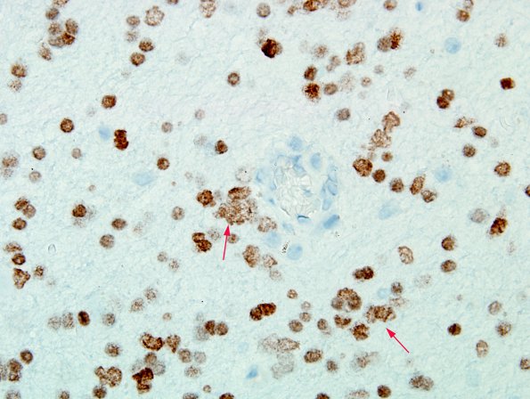 5B7 Microdysgenesis (Case 5) Olig2 WM 6