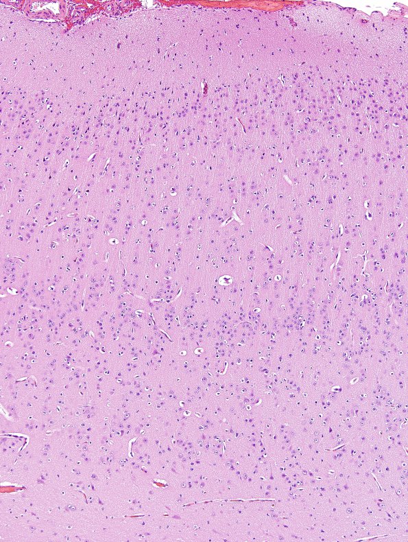 2A1 Focal Cerebral Dysplasia IIA (Case 2) A5 nl cortex H&E 10X