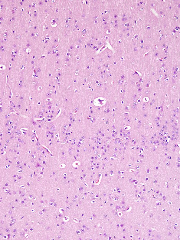 2A2 Focal Cerebral Dysplasia IIa (Case 2) A5 nl cortex H&E 20X