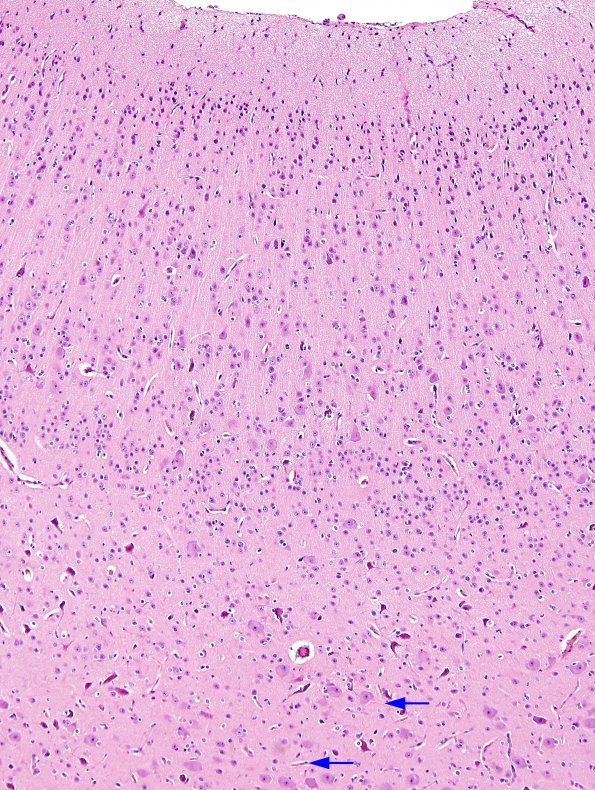 2A3 Focal Cerebral Dysplasia IIA (Case 2) A9 dysplastic cortex H&E 10X