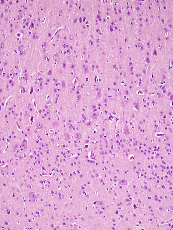 2A4 Focal Cerebral Dysplasia IIA (Case 2) A9 dysplastic cortex H&E 20X 1