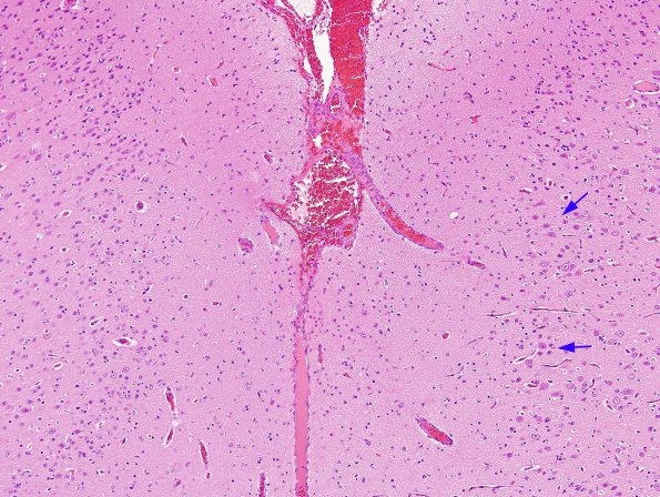 3A Cortical Dysplasia (Case 3) H&E 10