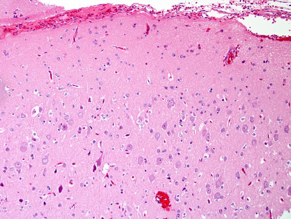 4 Focal Cortical Dysplasia (FCD, ILAE IIA, Case 4) H&E 2