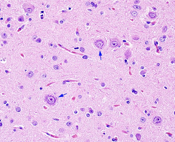 5A1 Focal Cortical Dysplasia IIA (Case 5) H&E 5