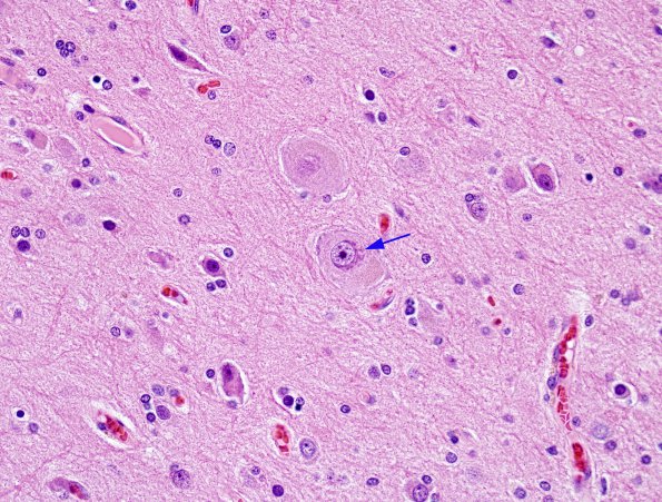 7A1 Focal Cortical Dysplasia IIa (Case 7) H&E 3