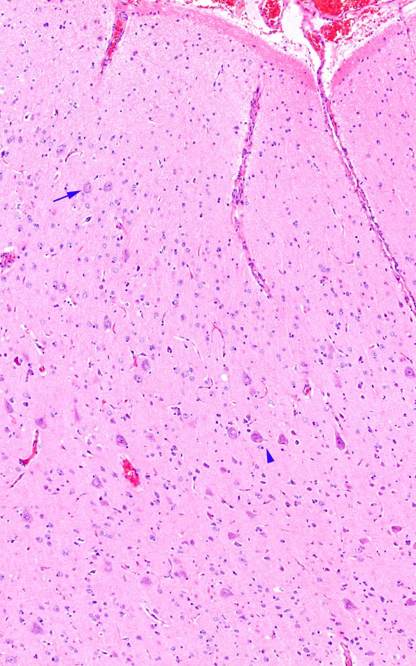 7A2 Focal cortical dysplasia IIa (Case 7) H&E A3 3 copy