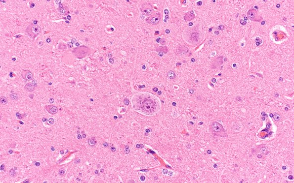 7A3 Focal cortical dysplasia IIa (Case 7) H&E A3 2