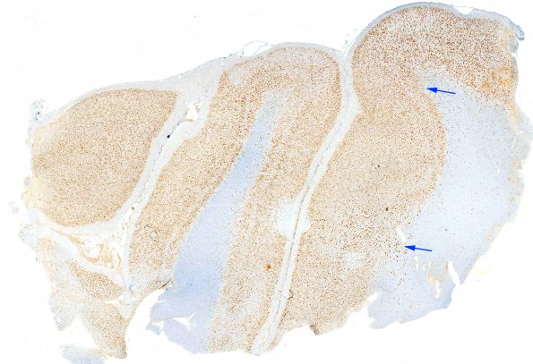 7B1 Focal cortical dysplasia IIa (Case 7) Neu-N whole mount copy copy