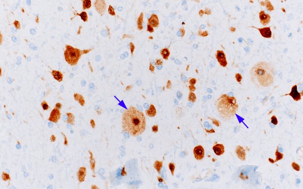 7B2 Focal Cortical Dysplasia IIa (Case 7) NeuN 4