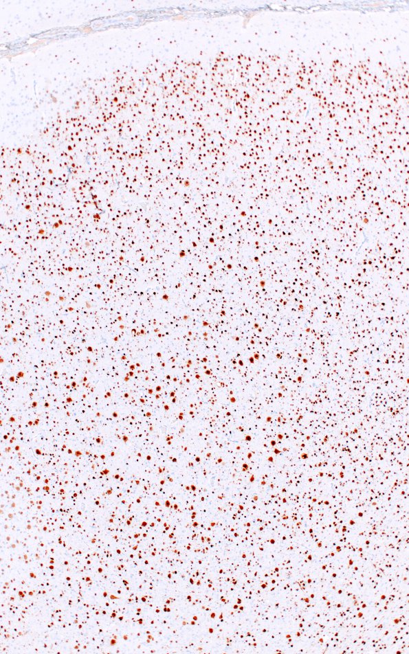 7B3 Focal cortical dysplasia IIa (Case 7) Neu-N 13A