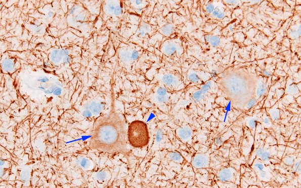 7B5 Focal cortical dysplasia IIa (Case 7) NF 3 copy