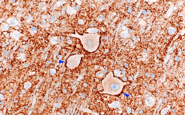 7B6 Focal cortical dysplasia IIa (Case 7) SYNaptophysin 1 copy