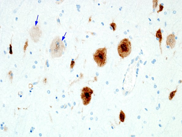 10A1 Focal Cortical Dysplasia (Case 14) NeuN 2A