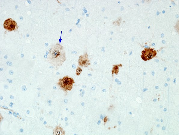 10A2 Focal Cortical Dysplasia (Case 14) NeuN 1A