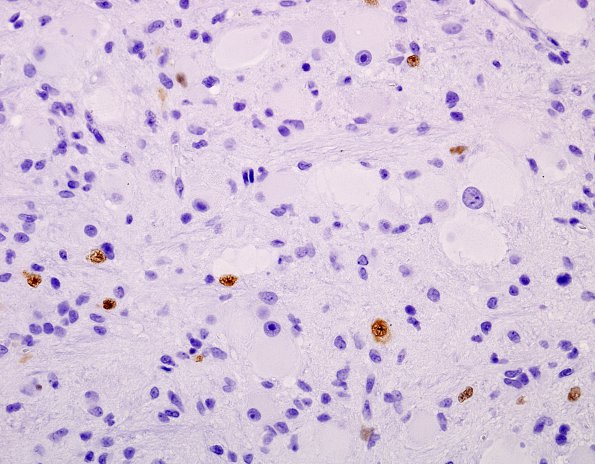 10A7 Focal Cortical Dysplasia (Case 3) NeuN 10