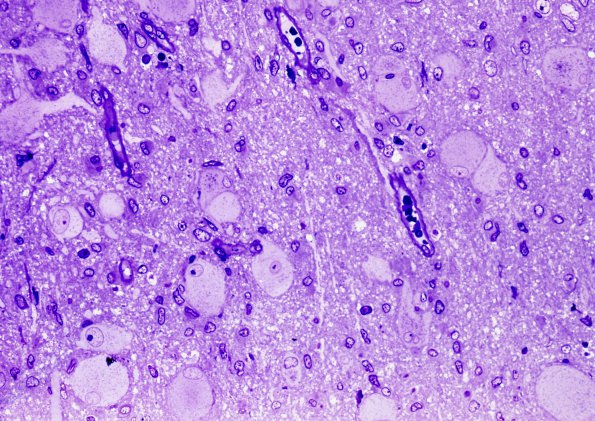 12A Focal Cortical Dysplasia (Case 8) Plastic 2