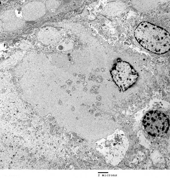 12B1 Focal Cortical Dysplasia (Case 8) balloon cell EM 028 - Copy